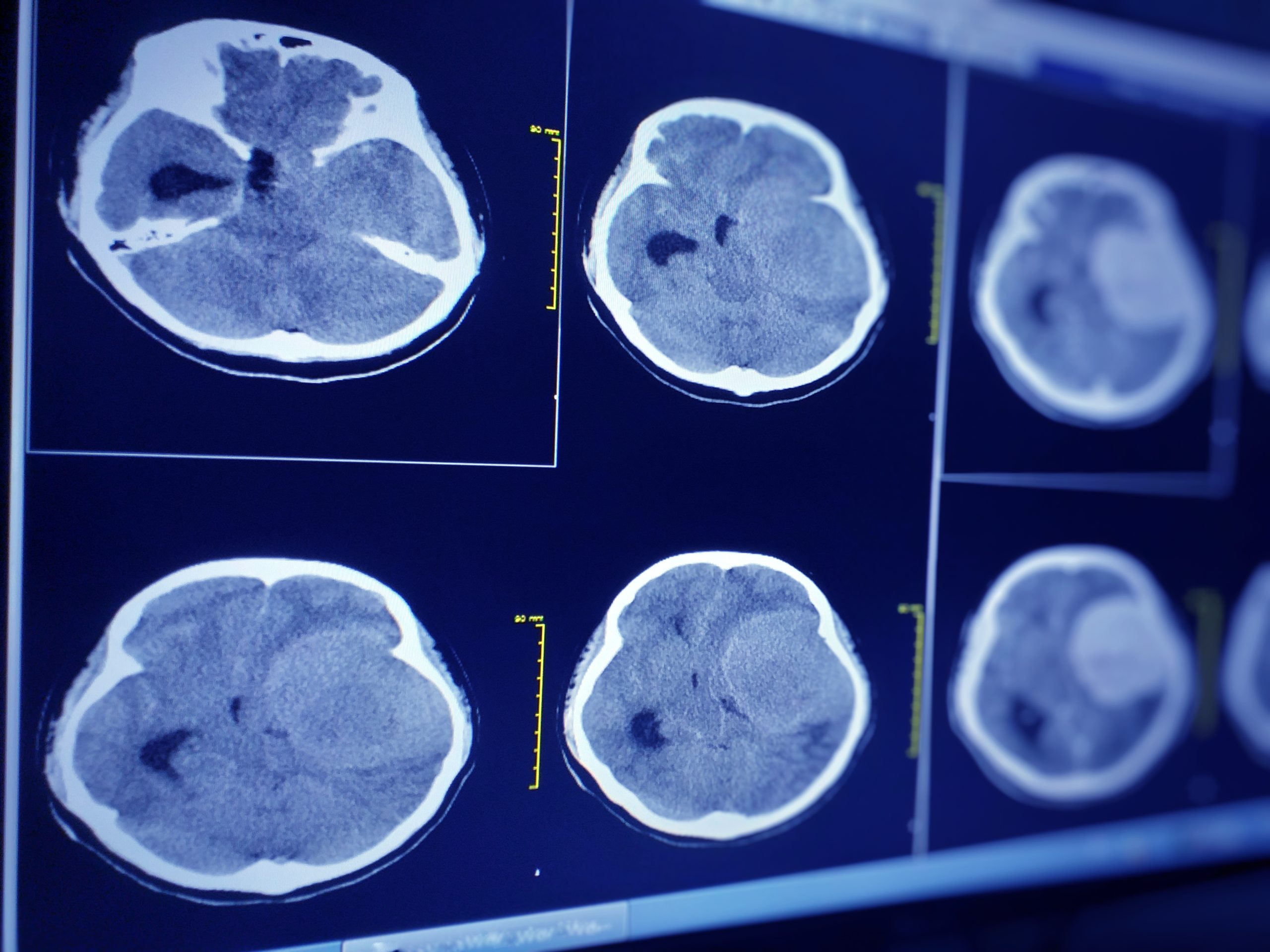 Faklis, Tallis & Mead - Chicago Traumatic Brain Injury Lawyers